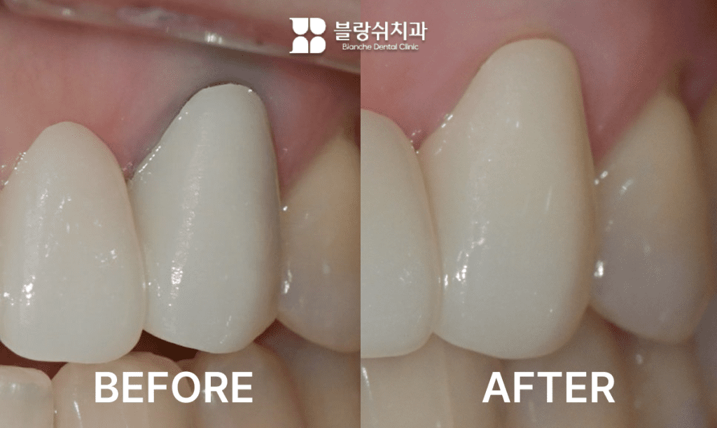 5.크라운 내부 변색 치아에 실활치미백 적용 전후 색조 변화 비교