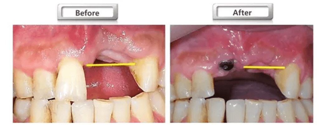6. 치조골 결손 부위 뼈이식 전후 구강 사진 비교