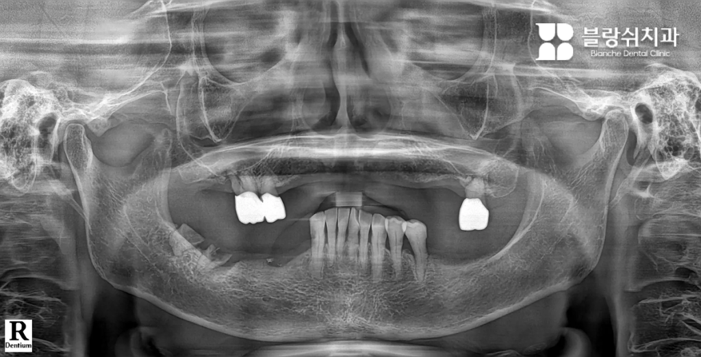 Case 1. 틀니와 장기 치료가 부담이었던 50대 남성