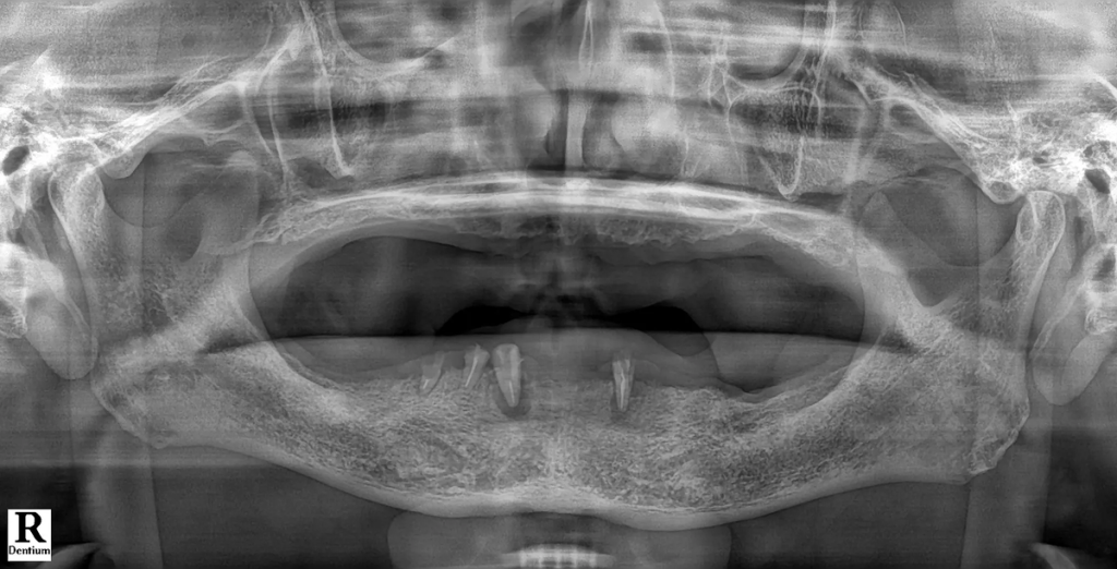 Case 3. 사고 후 뼈 부족으로 치료를 고민하던 40대 남성