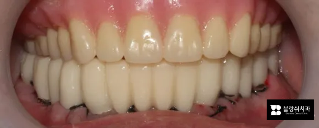 네비게이션 임플란트 후 임시치아를 낀 모습, 전체 치아 사진