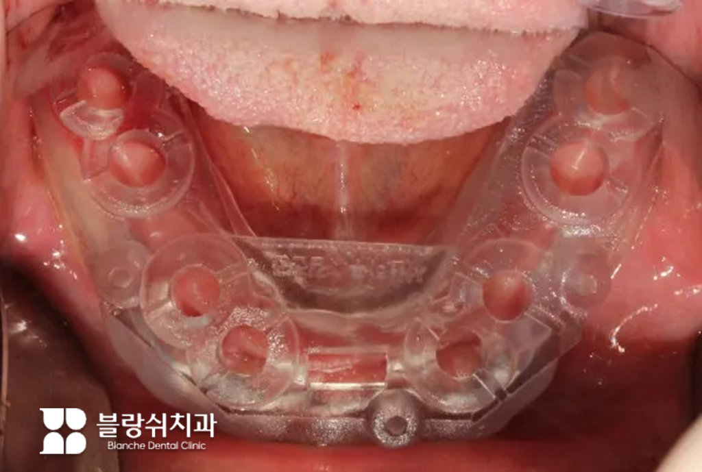 네비게이션 임플란트 전 네비게이션 가이드를 낀 모습