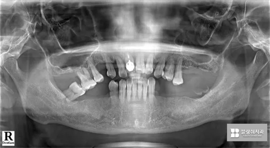 네비게이션 임플란트 시술 전 사진