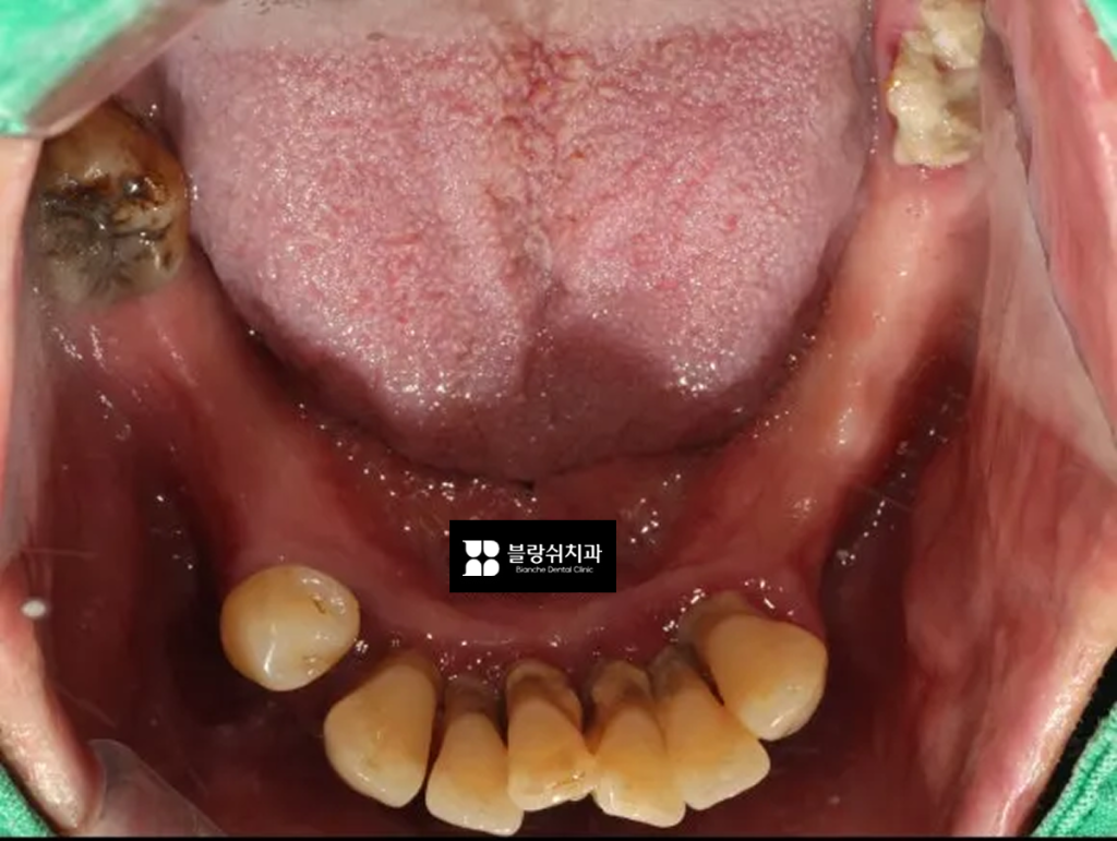 네비게이션 임플란트 시술 전 하악 사진