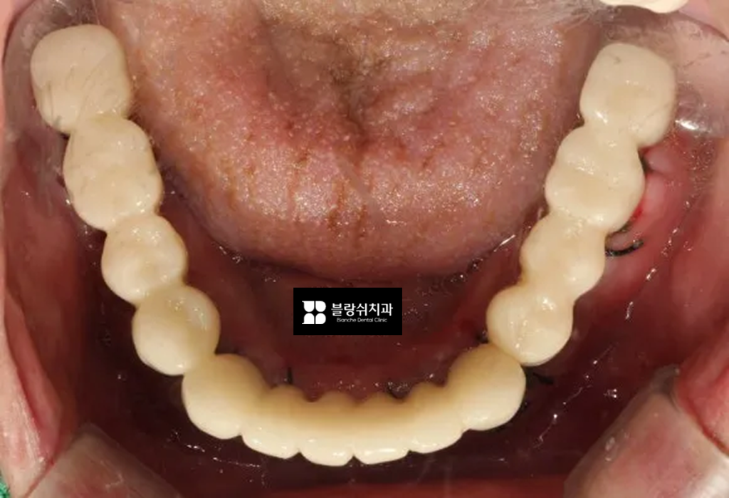 네비게이션 임플란트 후 임시치아를 낀 모습, 하악 사진