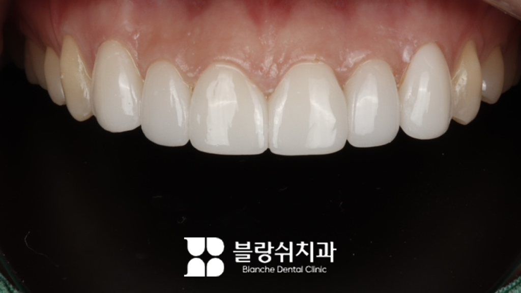 블랑쉬치과 무삭제 라미네이터 사진