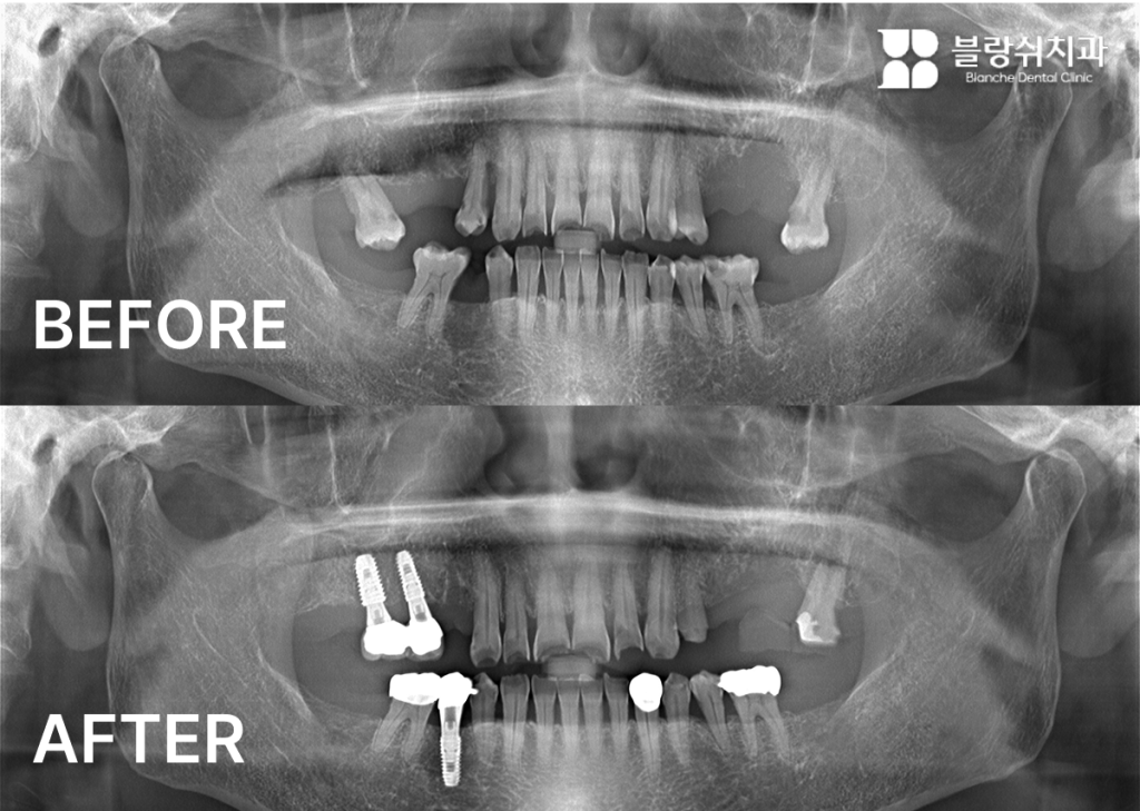 치과 공포증 환자가 수면 치료 치과를 통해 통증 걱정 없이 상악과 하악에 어금니 임플란트를 성공적으로 식립한 엑스레이 결과