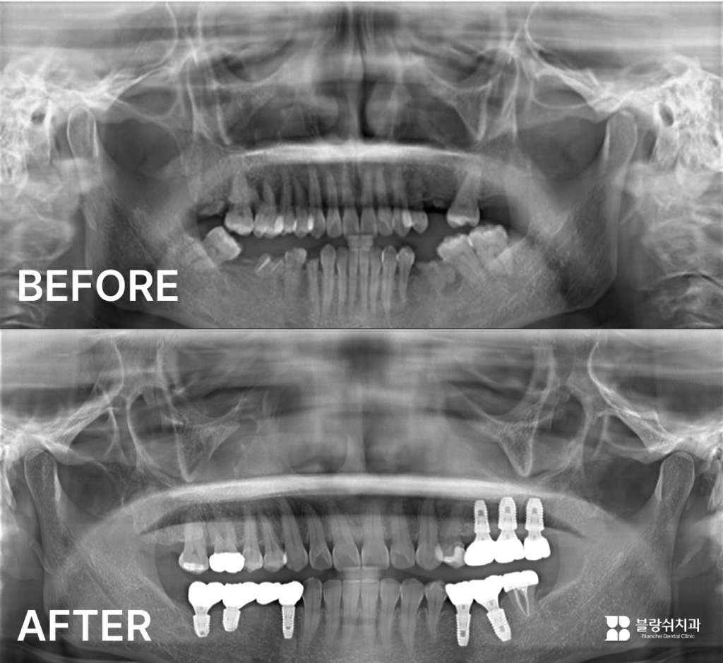 수면임플란트 시술 사례: 치과공포증 환자, 동시에 여러 시술 필요