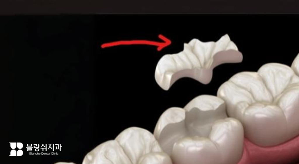 중기 충치 치료에 사용하는 인레이·온레이 보철 치료 예시 이미지
