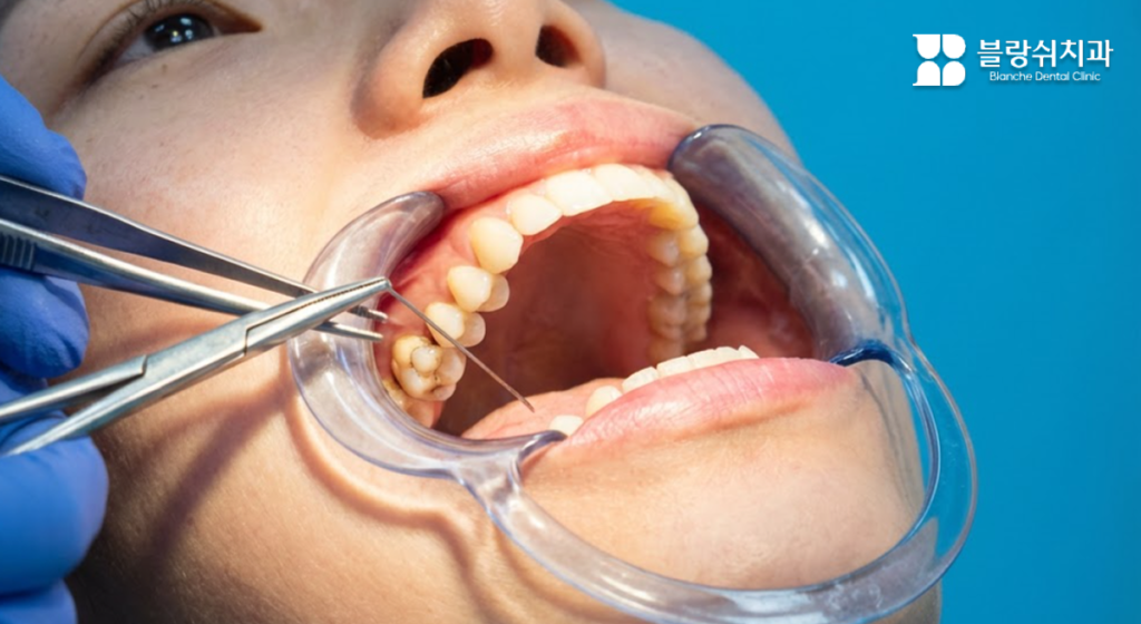 충치 진행 단계(초기·중기·중증·최종)별 치료 방법과 비용을 설명하는 이미지