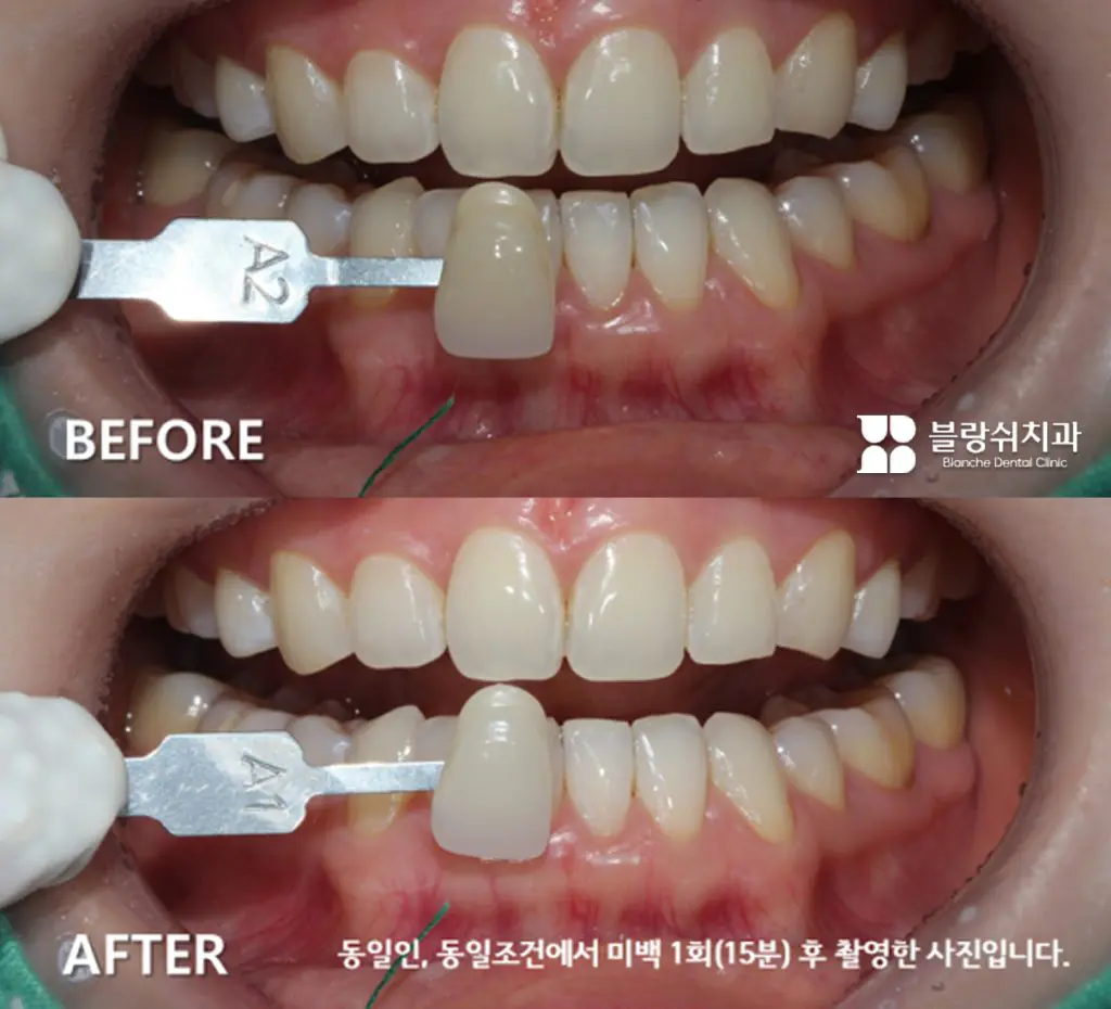 누런 치아로 고민하던 20대, 치아미백 사례