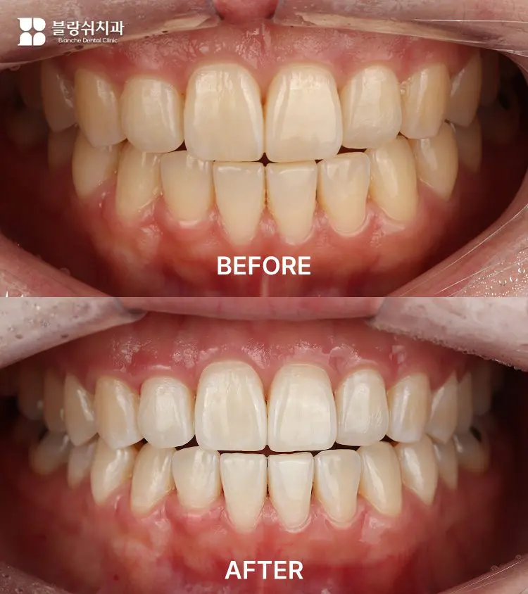5.치아미백 1회 전후 색상 변화를 쉐이드 가이드로 비교한 구강 사진