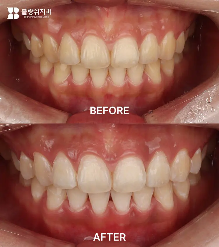 6.치아미백 전후 색상 변화를 쉐이드 가이드로 비교한 구강 사진