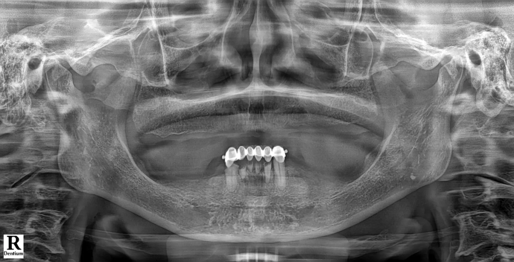 틀니 대신 디지털 풀아치 임플란트로 자신감을 찾으세요(실제 사례)