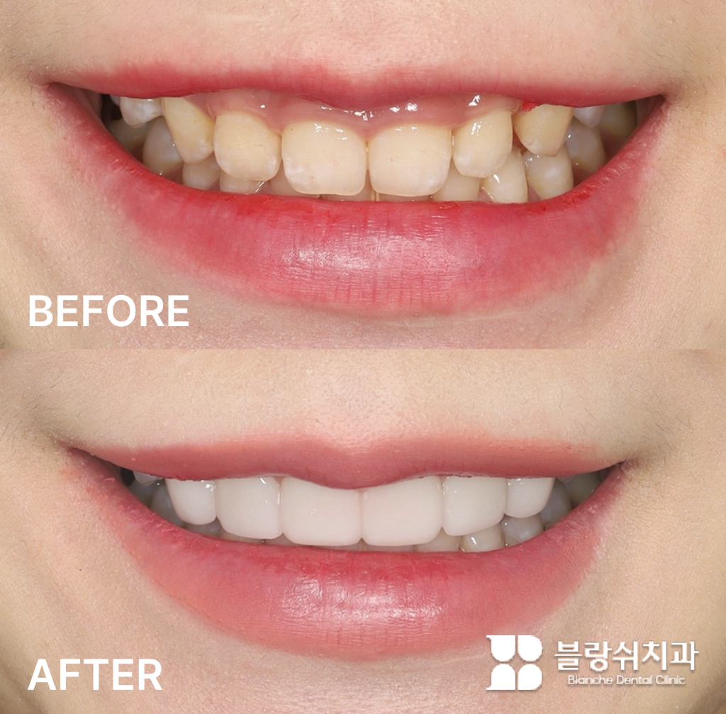 거미스마일과 불규칙한 치열을 개선한 라미네이트 시술 전후 비교