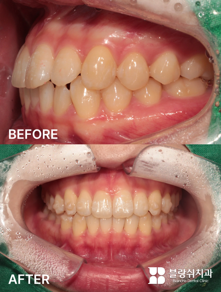 거미스마일과 부정교합을 함께 해결한 치아교정 전후 구강 상태