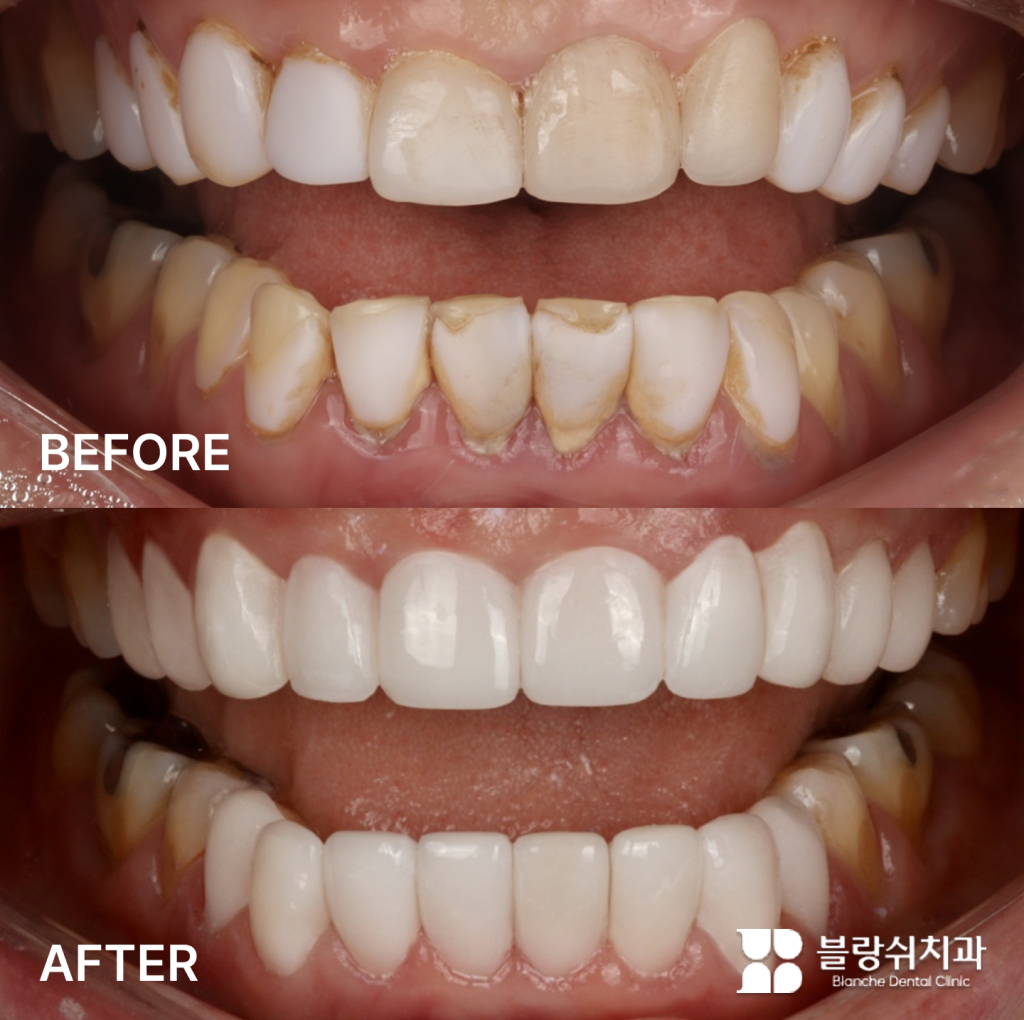 오래된 라미네이트 수명 저하로 인한 접착제 변색 및 파절