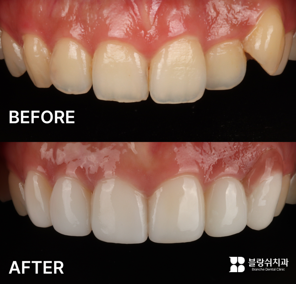 블랑쉬치과 배열이 좋지않은 앞니 라미네이트 시술 전후 비교