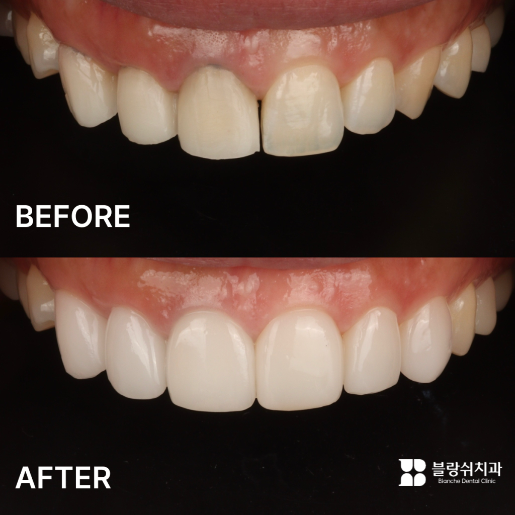 벌어진 치아를 자연스럽게 개선한 앞니 라미네이트 전후