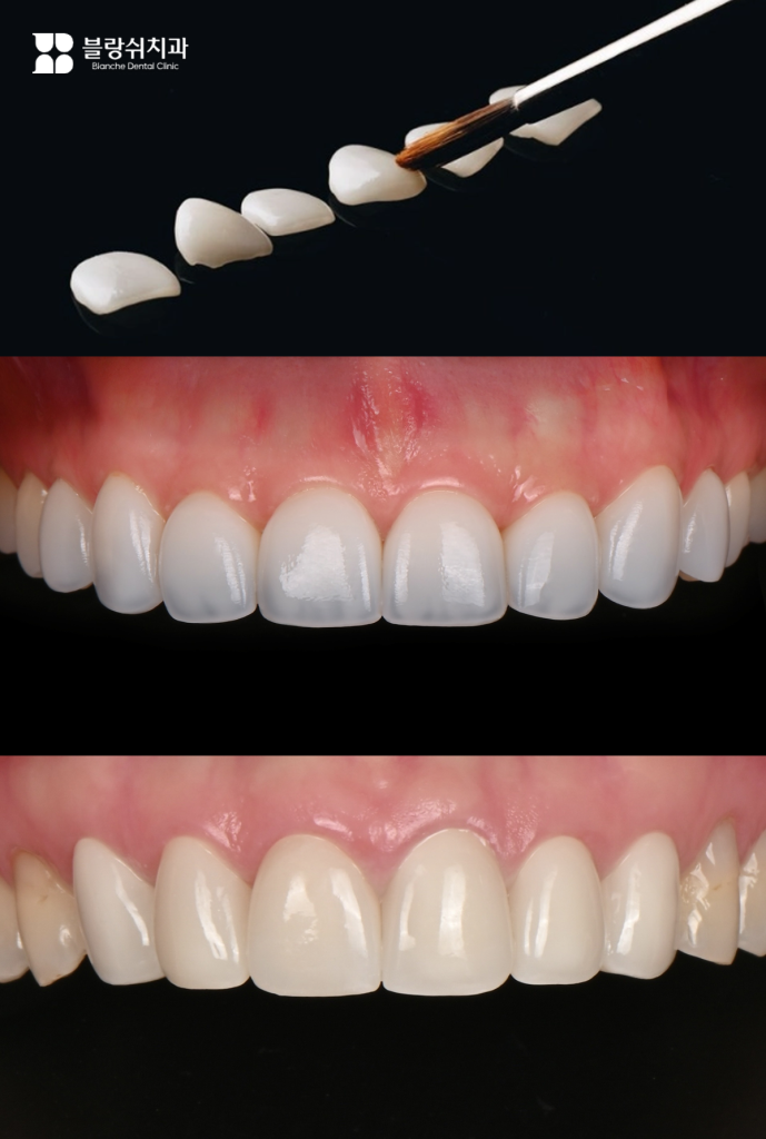 정교하게 제작된 블랑쉬 라미네이트 성공 사례