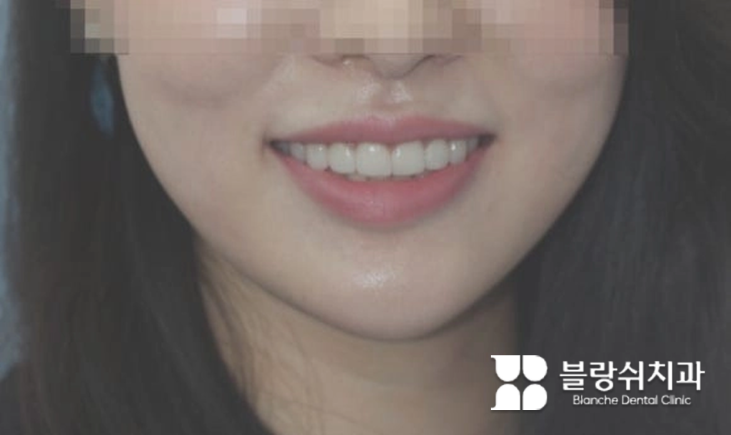 시술 후 밝고 가지런한 치아를 뽐내는 라미네이트 미소