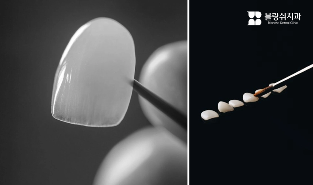 정교하게 제작된 라미네이트 팁의 디테일과 배열