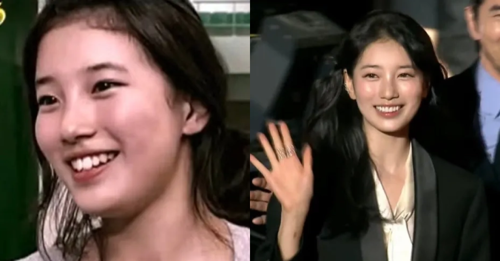 라미네이트 교정으로 덧니 없이 가지런한 치아를 뽐내는 수지