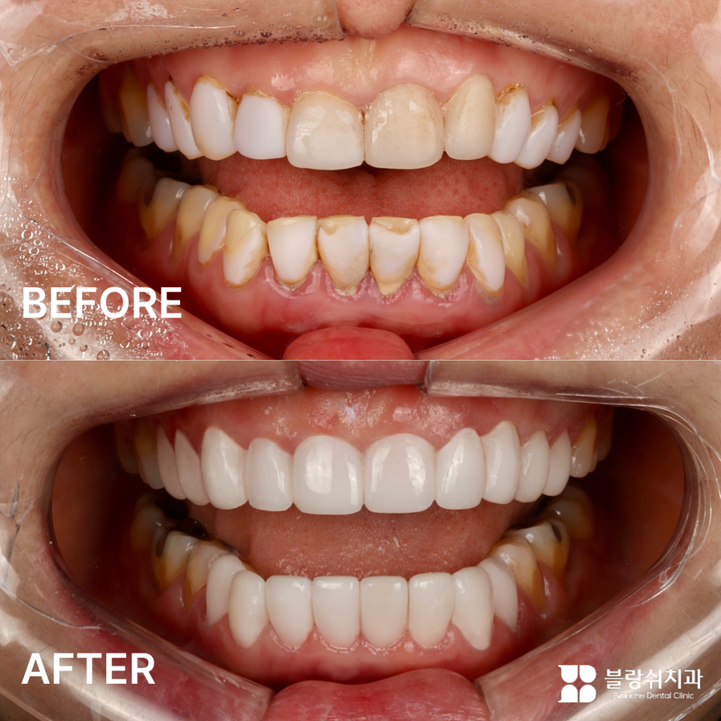 심한 변색과 불규칙한 치열을 개선한 앞니 라미네이트 전후