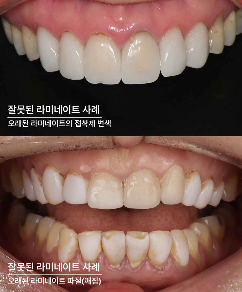 라미네이트 수명이 다해 파절된 치아를 재시술한 전후 비교