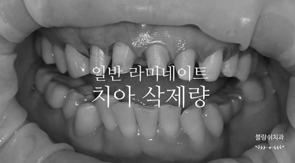 일반 라미네이트 치아 삭제량이 많은 앞니 치아
