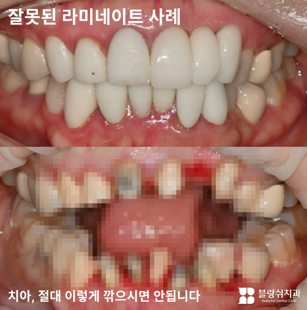 라미네이트 부작용 전후 비교 및 치아 삭제 주의 안내