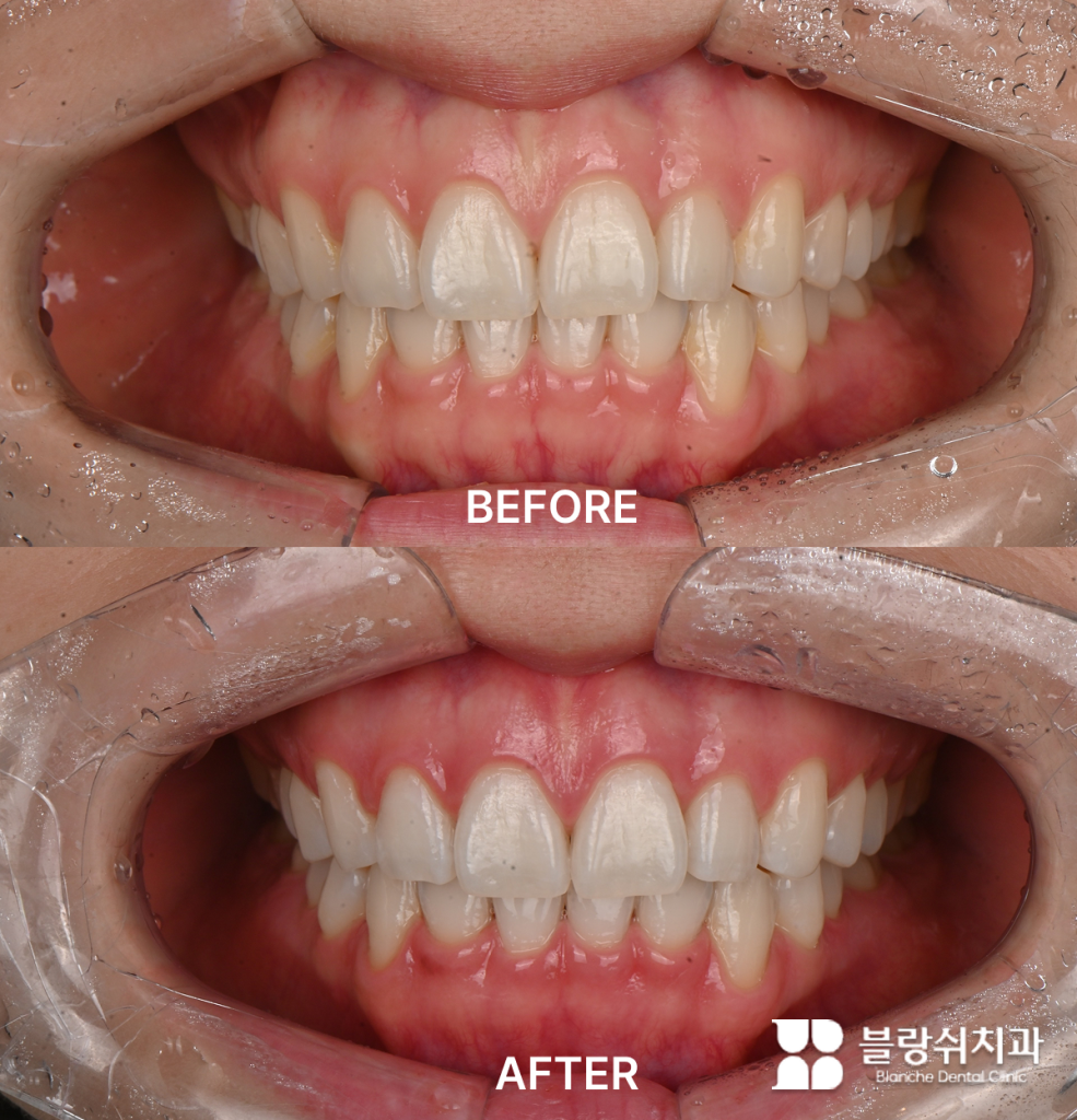 치아미백 치료로 누런 변색이 개선된 치아 비교 사진