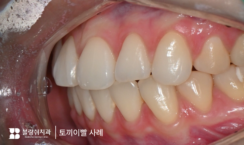 토끼이빨로 앞니가 돌출되어 보이는 고민을 표현한 이미지