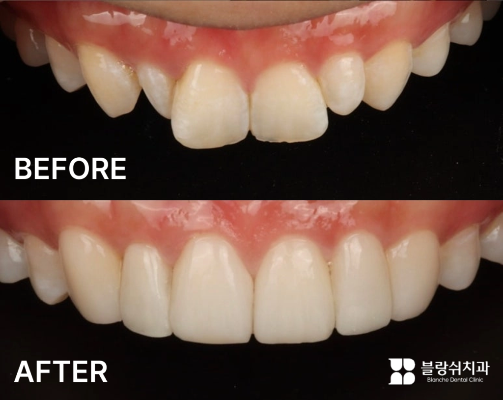 토끼이빨의 라미네이트 전후 비교 사례 이미지(토끼이빨·왜소치·변색 개선)