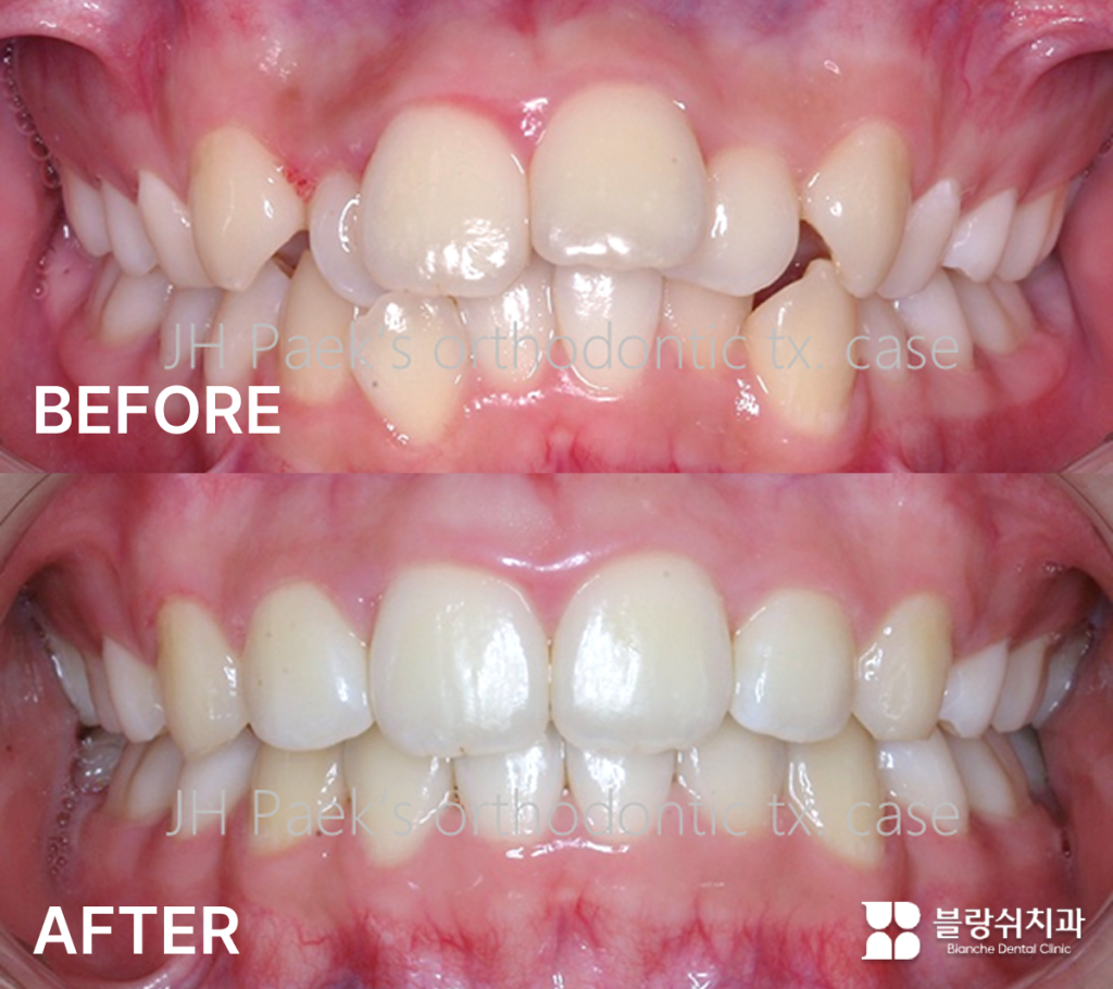 토끼이빨의 인비절라인 교정 전후 비교 사례 이미지(앞니 돌출·덧니 개선)