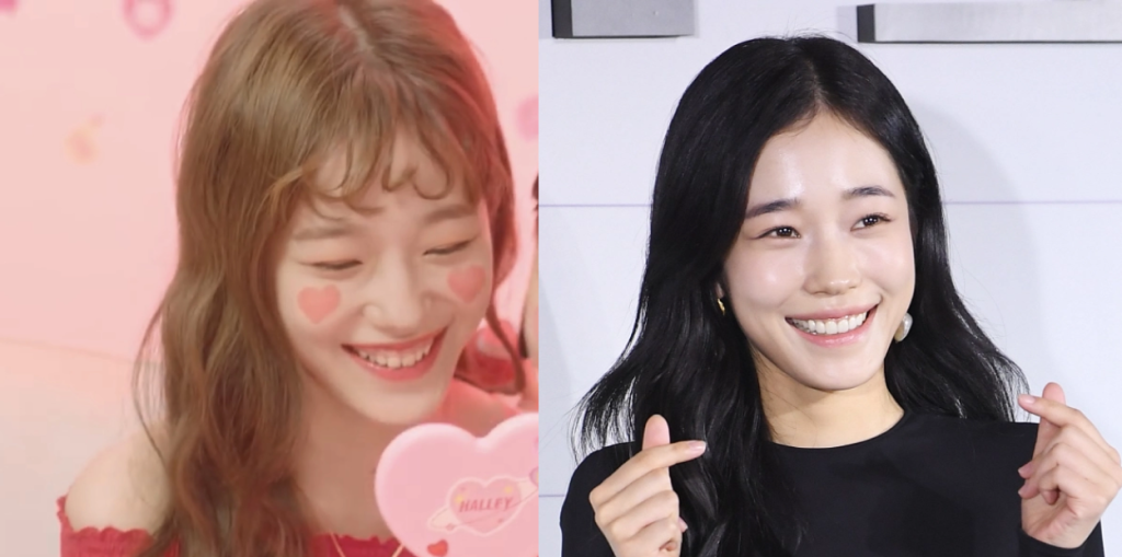 노윤서 거미스마일 개선과 라미네이트 전후 비교