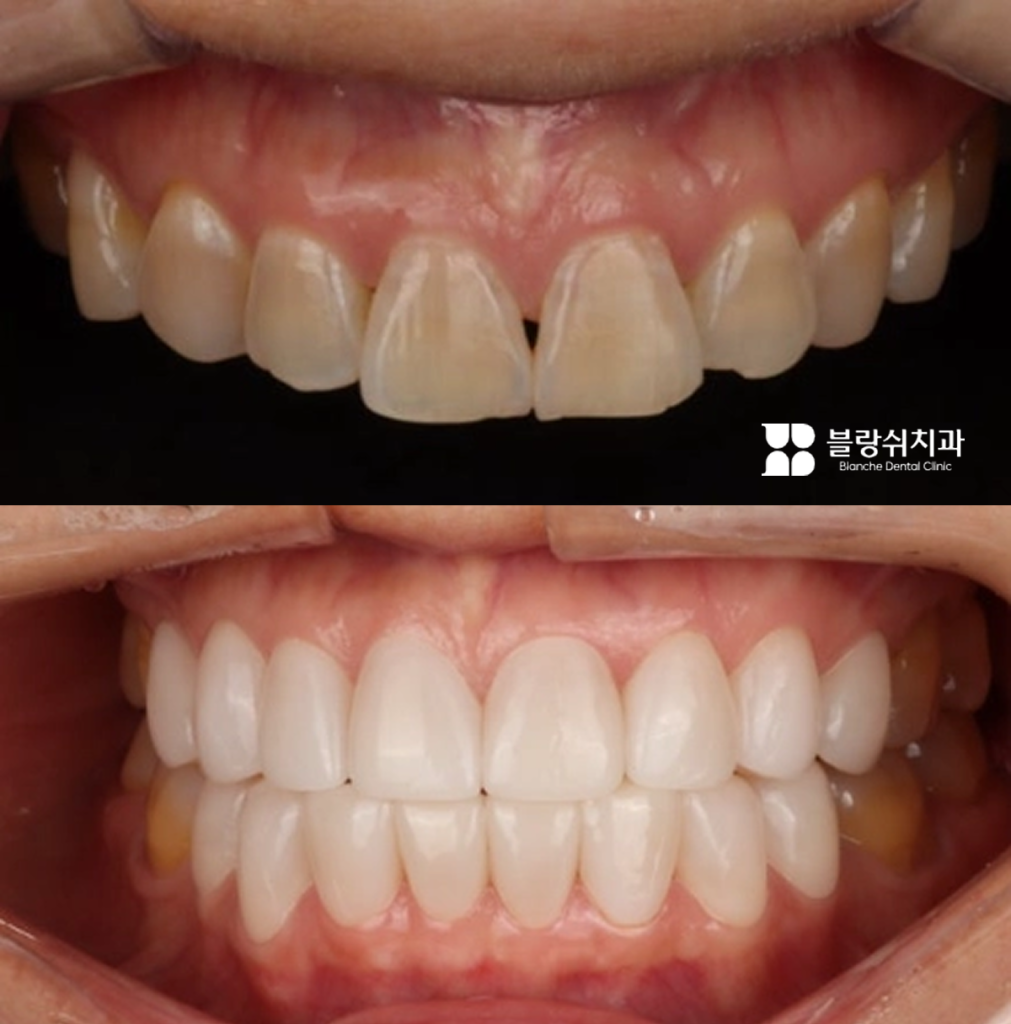 치아 틈새와 변색을 개선한 무삭제 라미네이트 시술 전후