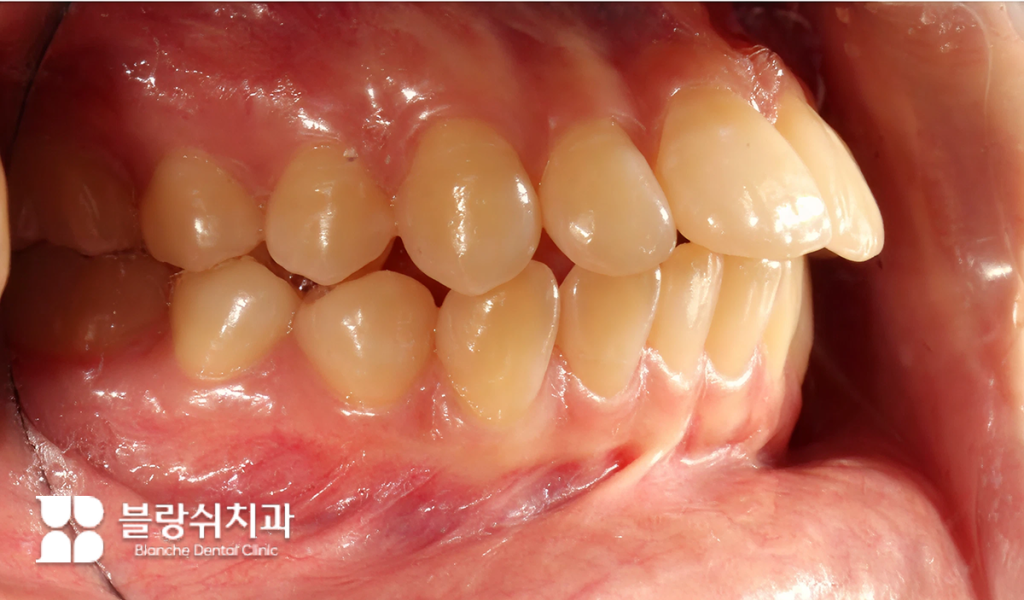 교정치료가 필요한 돌출입 환자의 측면 치아 구조와 교합 상태