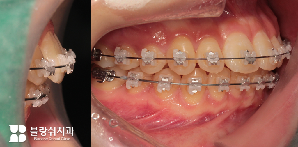 돌출입 교정을 위해 치아에 브라켓과 와이어 장치를 부착한 모습