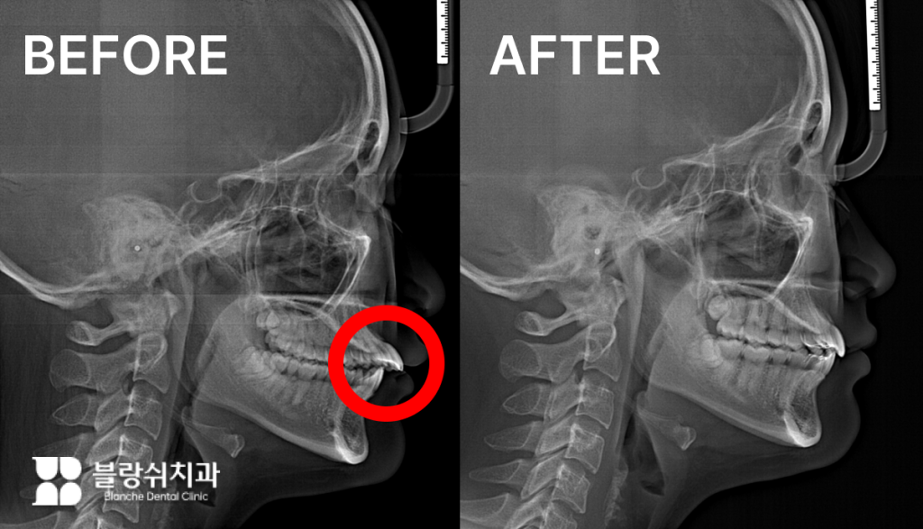 돌출입 교정치료 전후의 안면 골격 변화를 보여주는 엑스레이 비교