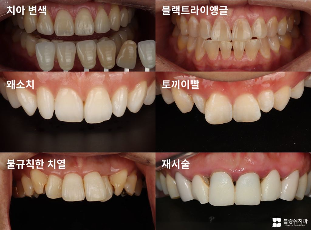 라미네이트 추천대상, 치아 변색, 블랙트라이앵글, 왜소치, 토끼이빨, 불규칙한 치열, 재시술