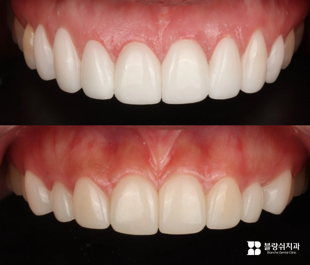 라미네이트란? 치아성형 사진