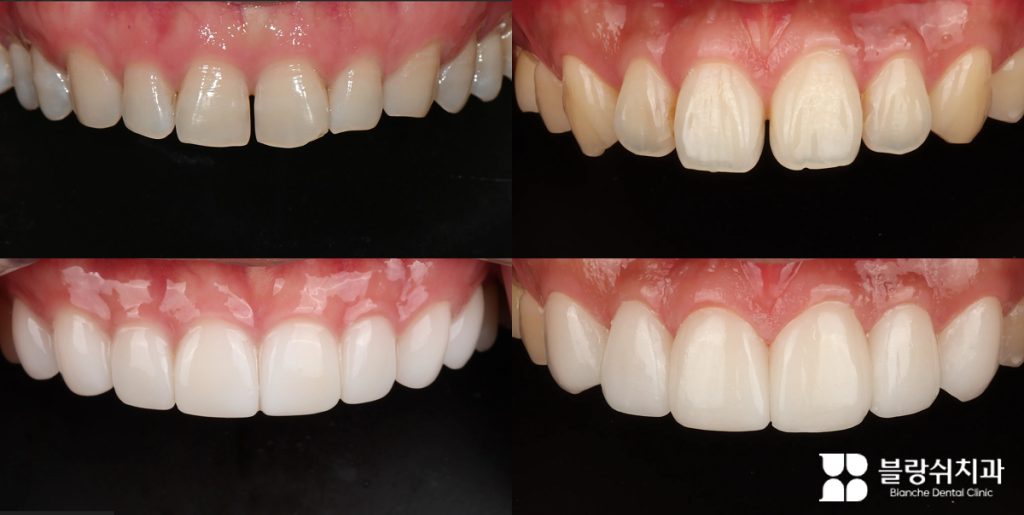 무삭제 라미네이트 블랑쉬