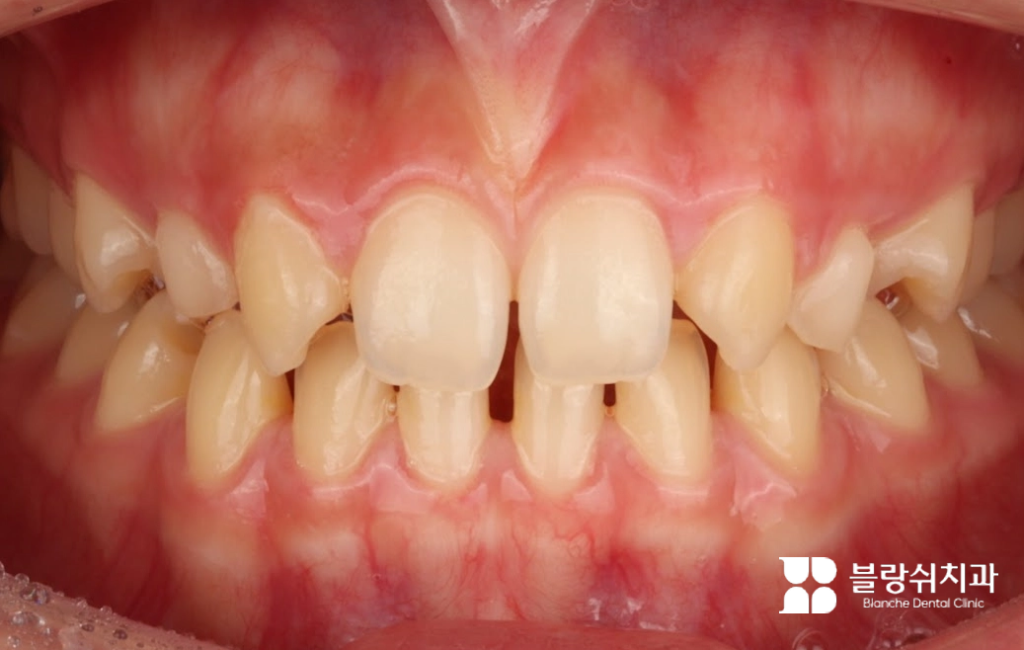 벌어진 치아 사진