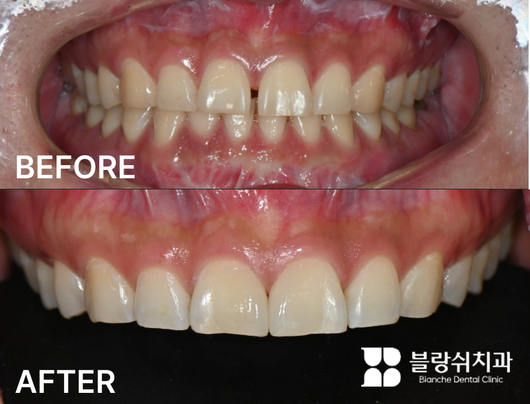 벌어진 치아 라미네이트 치료 전후사례