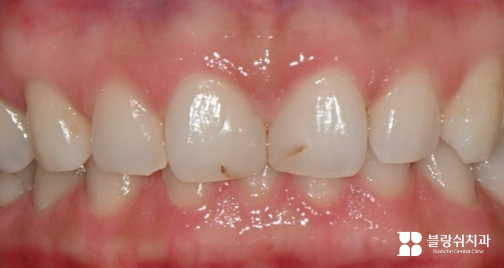 벌어진 치아 레진 부작용