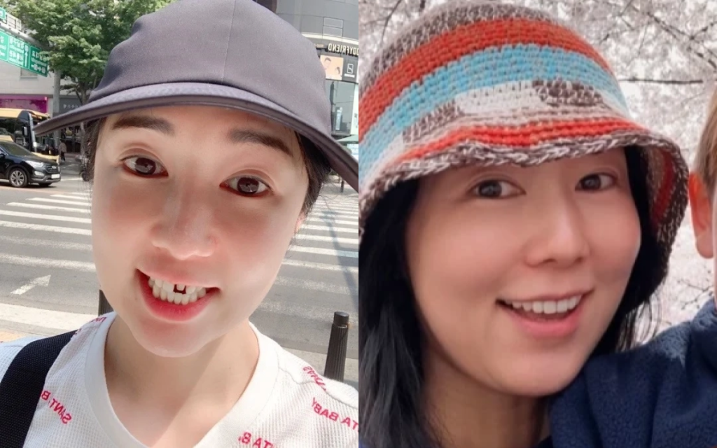 사유리 크라운 치아 삭제