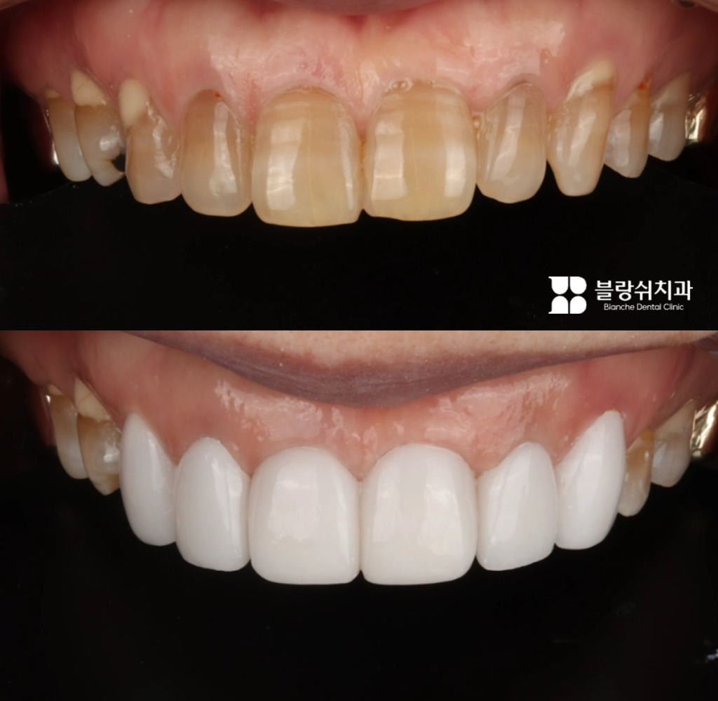 치아 틈새와 변색을 개선한 무삭제 라미네이트 시술 전후