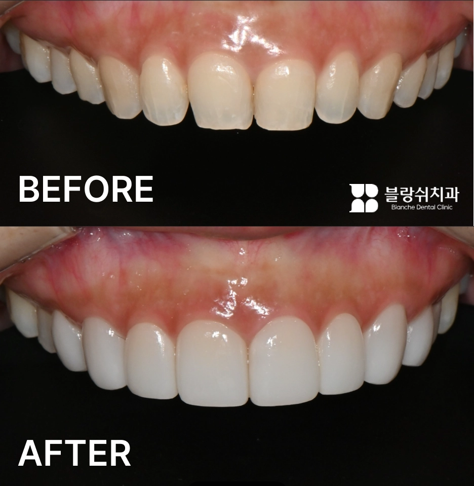 윗니 옥니 라미네이트 전후 정면 비교