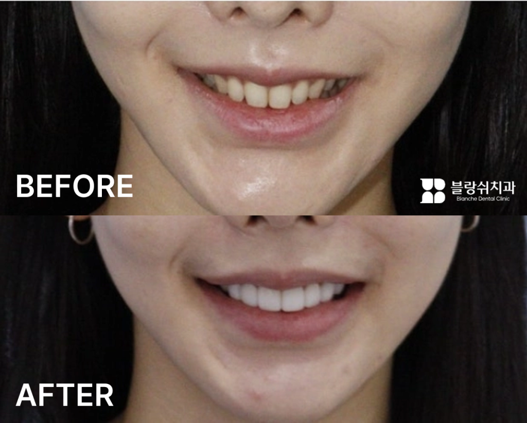 상악 옥니 라미네이트 전후 치아 형태 비교